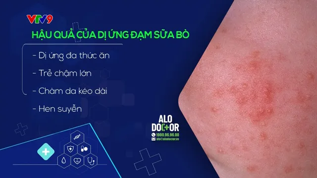 Bản tin Alo Doctor (ngày 23/9/2024): Dị ứng đạm sữa bò ở trẻ em